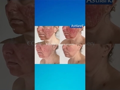 HIFU vs. Kısmi CO2 Lazer, hangisini tercih edersin?