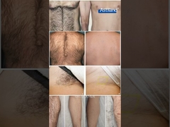 Lazer saç çıkarma öncesi ve sonrası