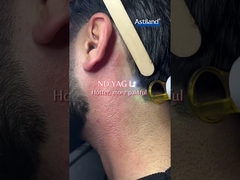 Diyot Lazer vs. ND YAG Lazer, hangisini tercih edersin?