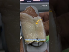 HIFU'nun anında kaldırma etkisini kontrol edelim