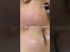 Hassas cilt bakımı için HydraFacial tedavisi