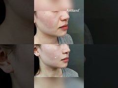 Cilt Sıkılaştırma İçin RF+ HIFU'yu Deneyiniz mi? #YaşlanmaKarşıtı #CiltGerme #güzellikmerkezi #yüzbakımı